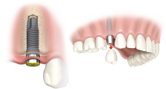 Dental Implant 